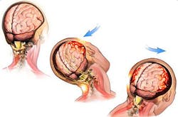 DARPA seeks to develop implantable device to help brain-injured people regain their memories DARPA seeks to develop implantable device to help brain-injured people regain their memories